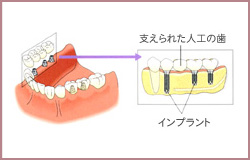 大岸歯科クリニックインプラントイラスト04