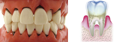 大岸歯科クリニック歯周病