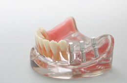 大岸歯科クリニックインプラント模型