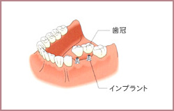 大岸歯科クリニックインプラントイラスト02