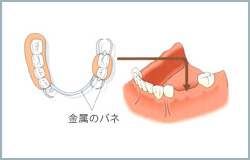 大岸歯科クリニックインプラントイラスト03