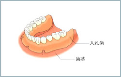大岸歯科クリニックインプラントイラスト05