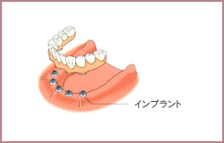 大岸歯科クリニックインプラントイラスト06